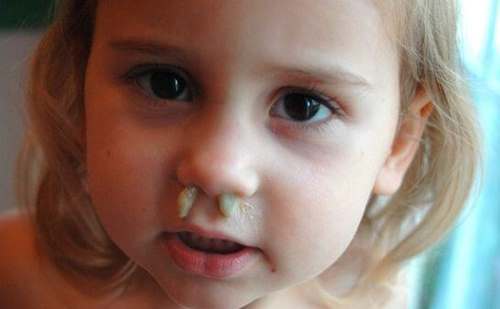 Как вылечить гнойный насморк (гайморит) у взрослого