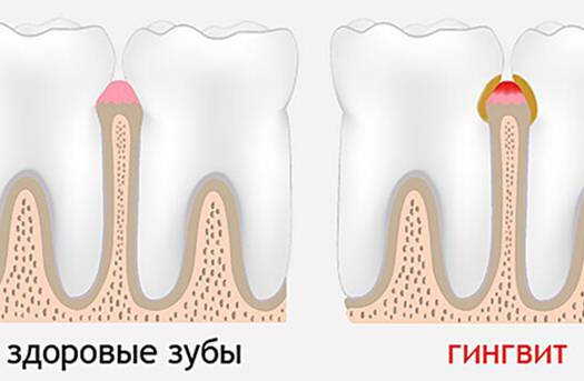 Гингивит: как лечить воспаление десен
