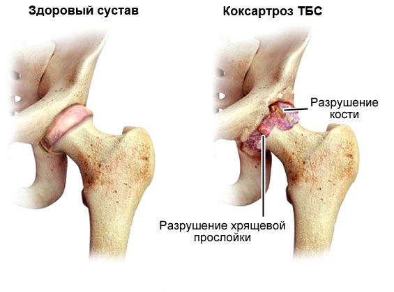 Питание при коксартрозе тазобедренного сустава лечение