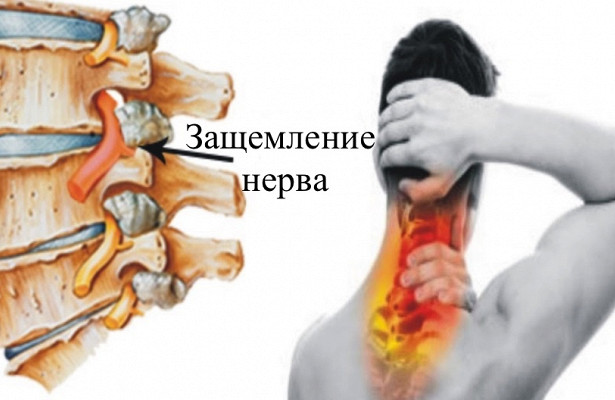 Защемление нерва в позвоночнике: симптомы и методы лечения