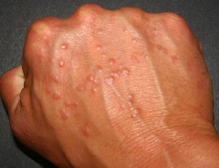 Аллергический дерматит у детей – симптомы, лечение, мазь от аллергического дерматита, диета при аллергическом дерматите