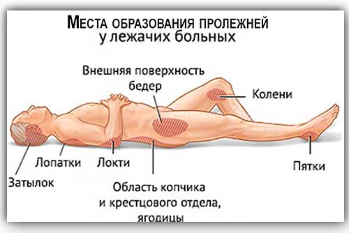 Средства лечения пролежней у лежачих больных дома