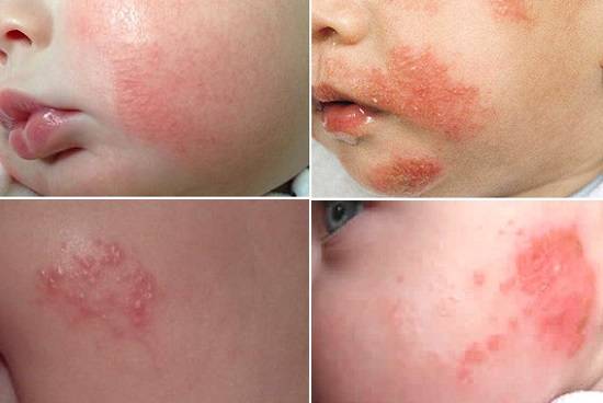 Аллергический дерматит у детей