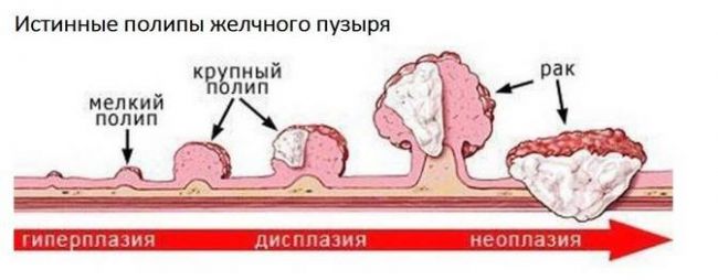 Полипы в желчном пузыре
