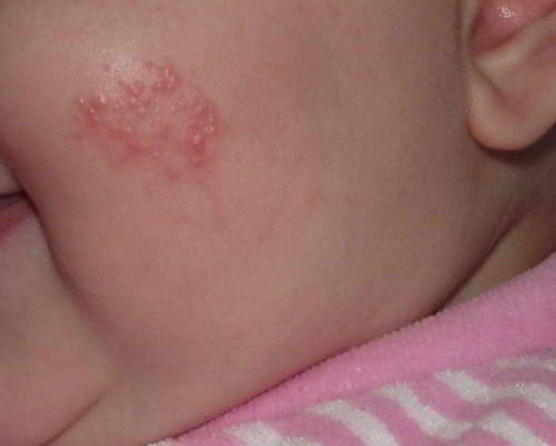 Аллергический дерматит: симптомы и лечение аллергического дерматита у детей и взрослых