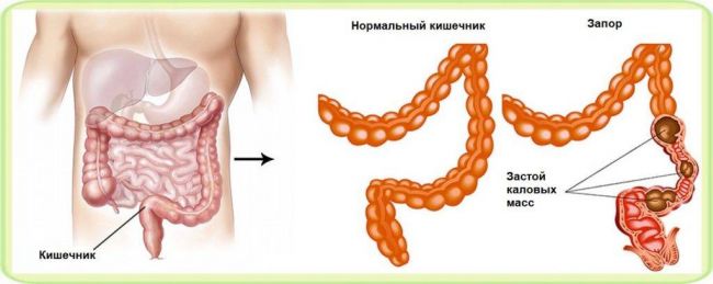 Запор у детей и взрослых: симптомы и лечение, эффективные слабительные средства
