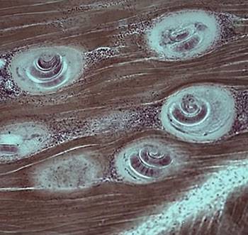 Трихинеллез: симптомы у человека и лечение трихинеллеза, источники трихинеллеза