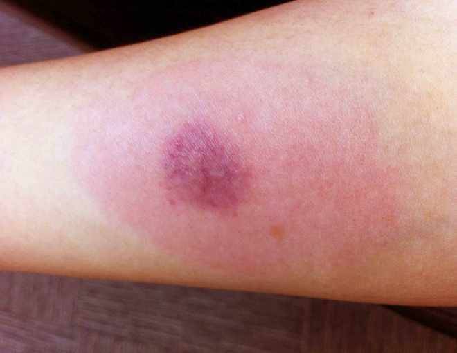 Через какое время проявляется след от манту?