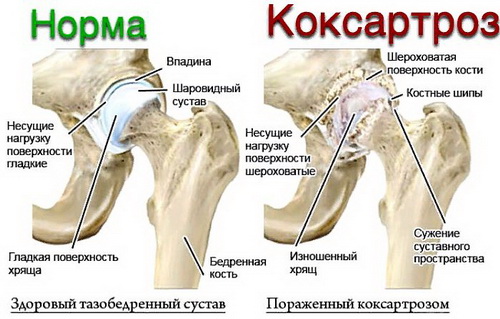 Лечение диетой коксартроза тазобедренного сустава