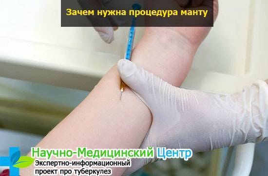 Допустимые размеры манту и норма у детей в зависимости от возраста