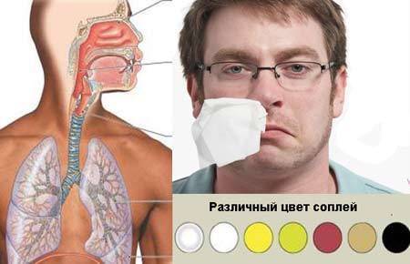 Гнойный ринит (насморк): симптомы и лечение у взрослых и детей