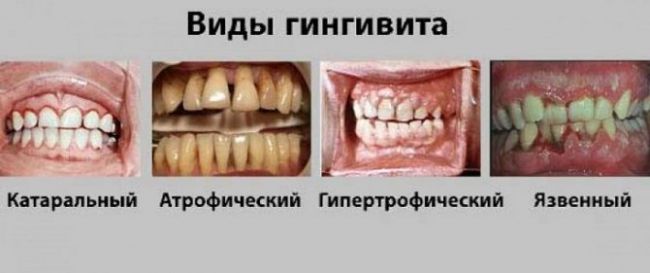 Гингивит у ребенка: симптомы и лечение