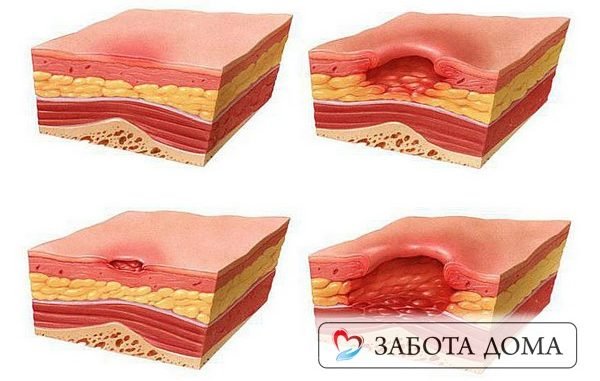 Пролежни у лежачих больных: лечение в домашних условиях, эффективные средства от пролежней