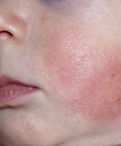 Как справиться с аллергическим дерматитом у детей: выбор правильного лечения и диеты