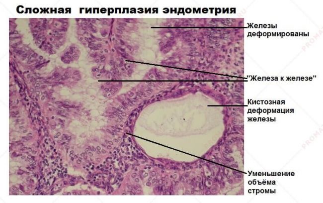 Железистая гиперплазия эндометрия: причины, диагностика, принципы лечения