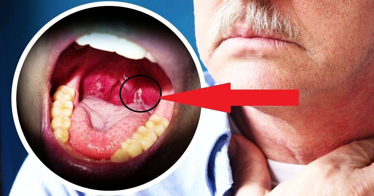 Жжение в горле: причины, симптомы, лечение