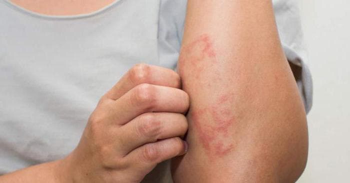 Дерматит — в поисках причин возникновения и эффективного лечение (64 фото + видео)