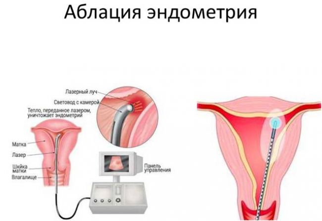 Железистая гиперплазия эндометрия