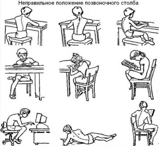 Поясничный лордоз: как распознать и что делать
