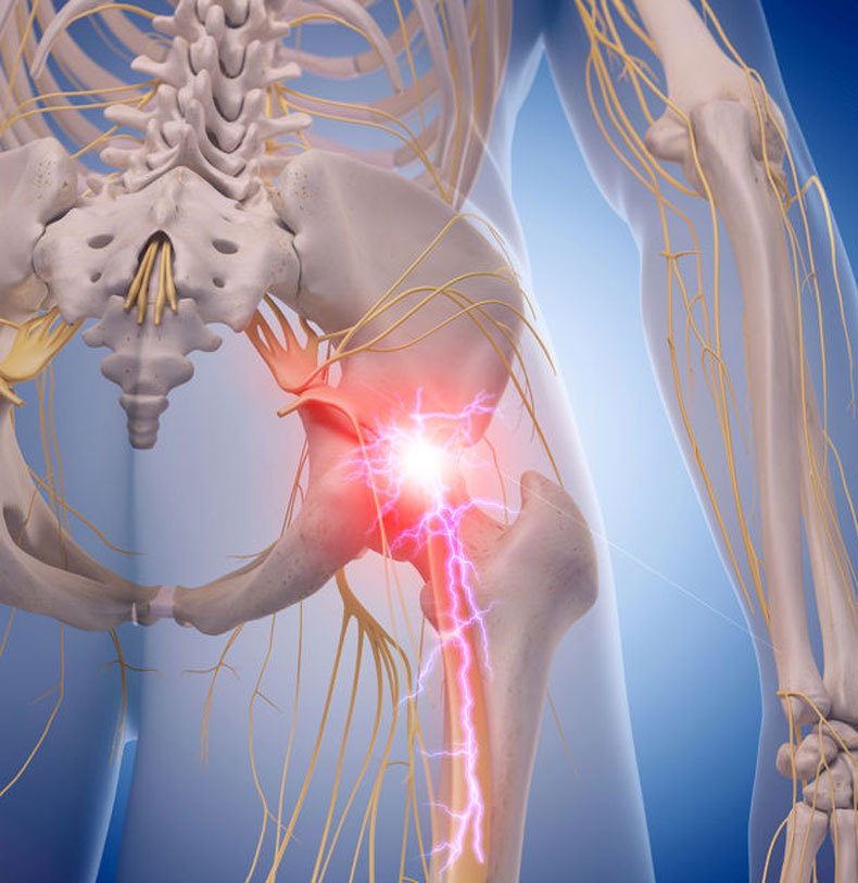 Ущемление нерва в поясничном отделе позвоночника лечение