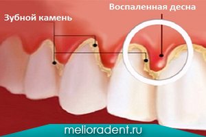 Гингивит – симптомы, классификация и лечение