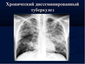 Инфильтративный туберкулез легких