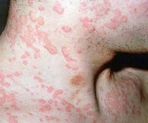 Пищевая аллергия