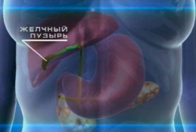 Как лечится холестериновый полип желчного пузыря?