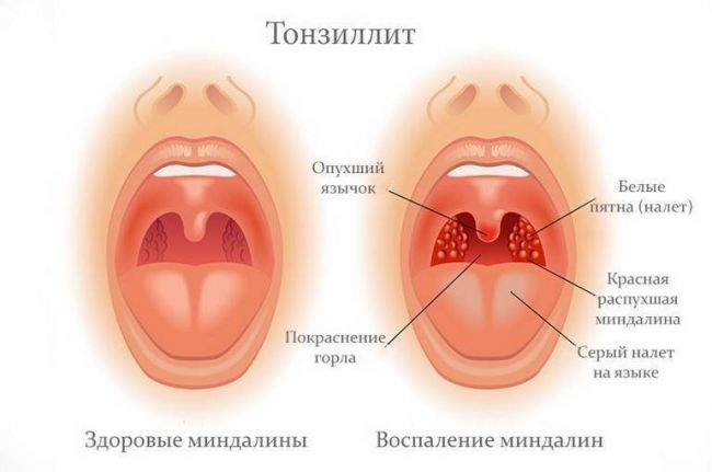Пониженная температура при простуде