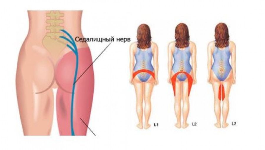 Что делать, если защемило спину: мази, уколы, таблетки, упражнения для лечения