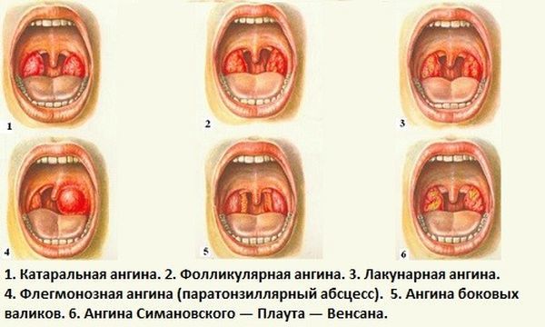 Стрептоцид таблетки от боли в горле — инструкция по применению, цена, состав и аналог