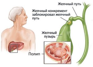 Основы питания при полипах в желчном пузыре — диета №5