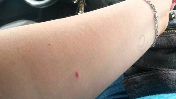 Через какое время проявляется след от манту?