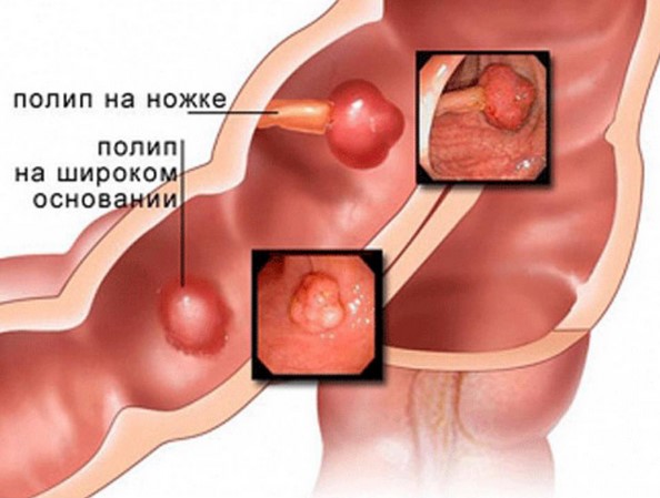 Полип желчного пузыря. причины, симптомы, диагностика, лечение и профилактика :: polismed.com