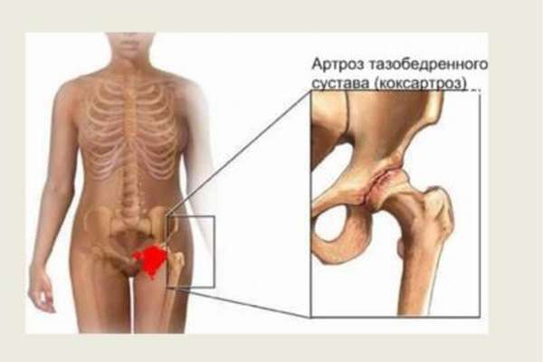 Принципы диетического питания при коксартрозе