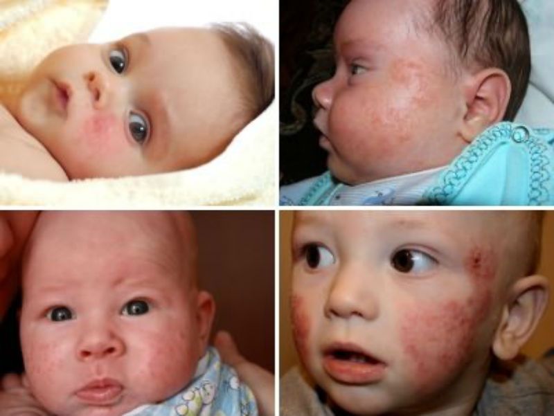 Аллергический дерматит: симптомы и лечение аллергического дерматита у детей и взрослых