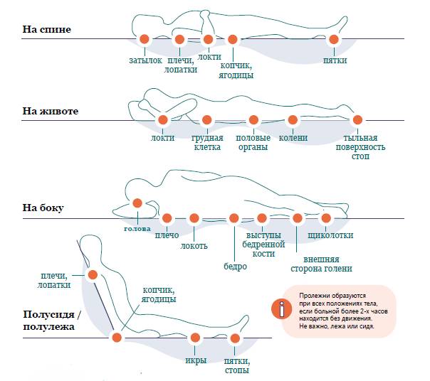Пролежни: лечение и профилактика, средства для обработки