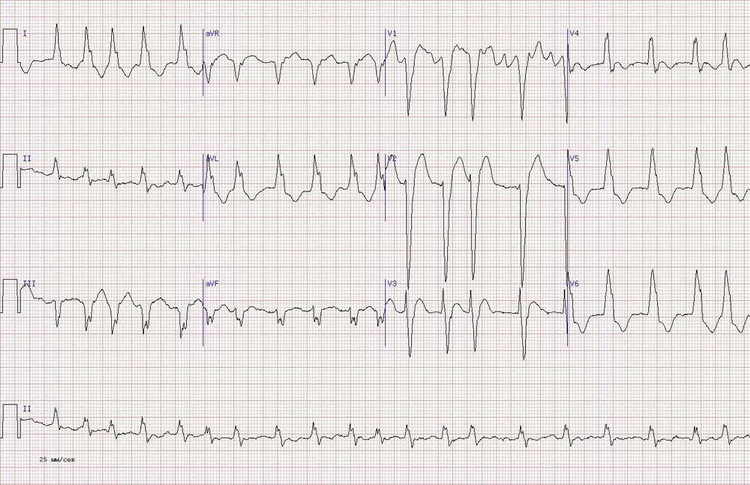 Аритмия на ЭКГ