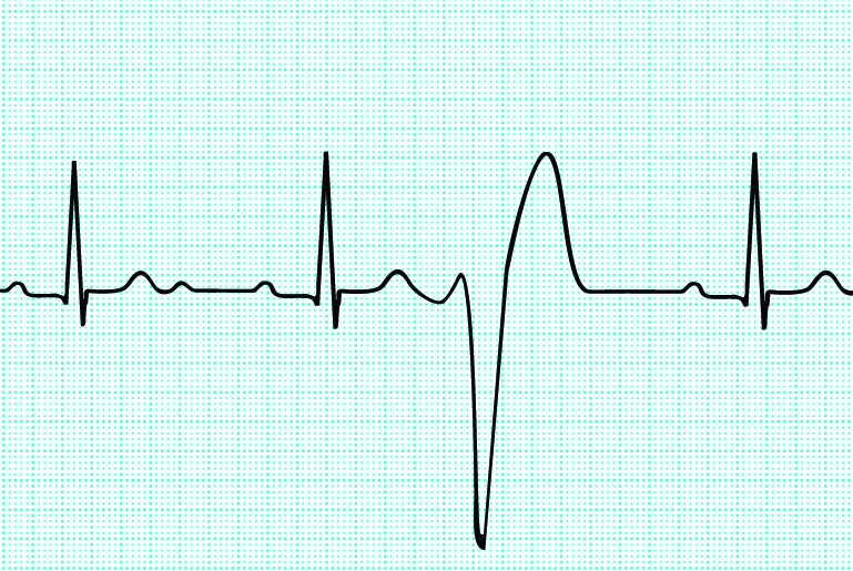  Аритмия сердца