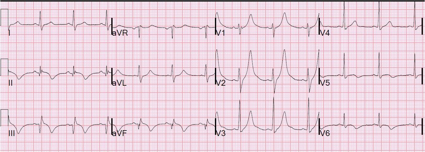Инфаркт миокарда на ЭКГ