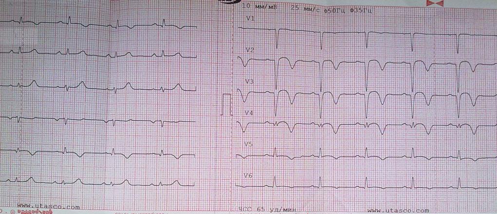  Инфаркт миокарда на ЭКГ