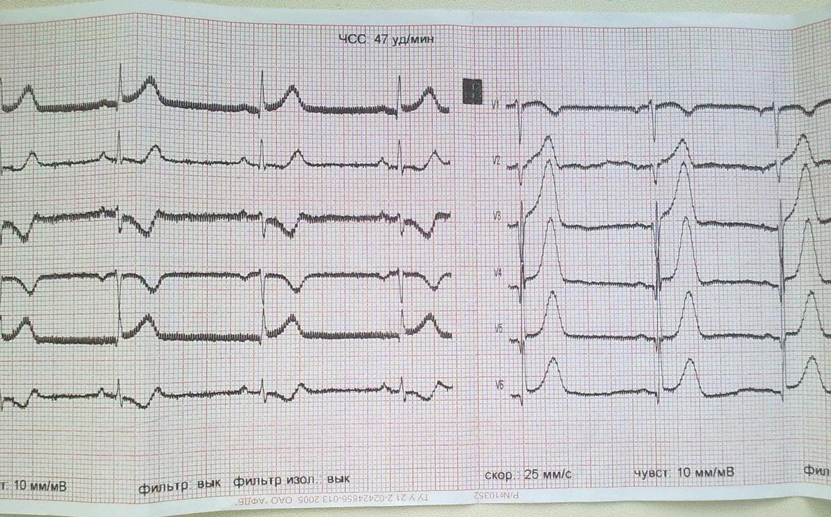 ЭКГ при ИМ