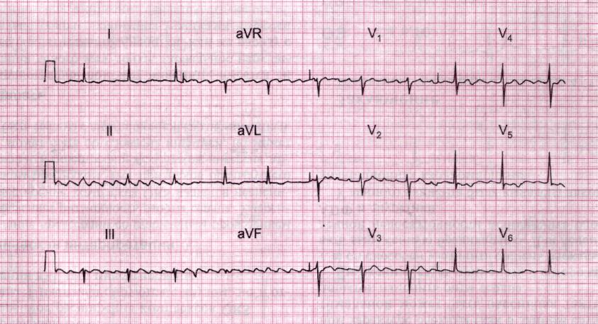 ЭКГ при сердечной недостаточности