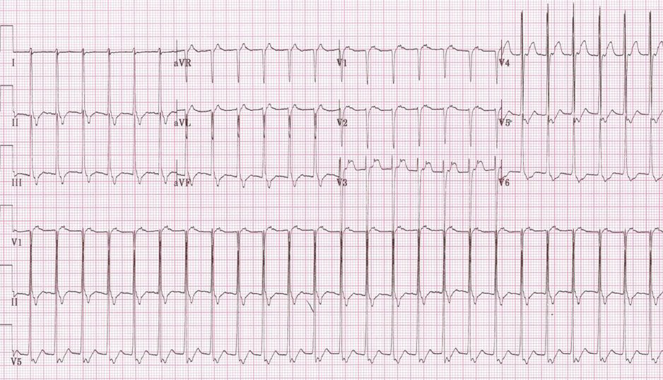 Кардиограмма физиологической тахикардии