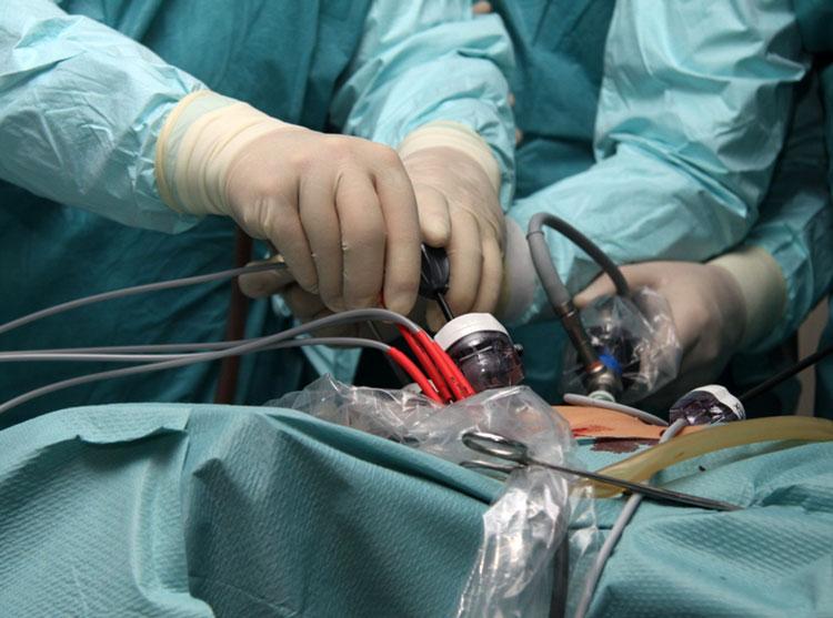 Криоабляция