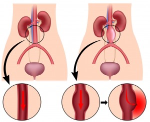 Нарушение целостности сосуда