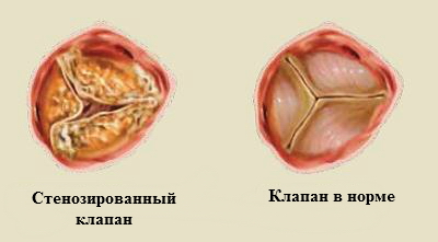 Особенности развития заболевания