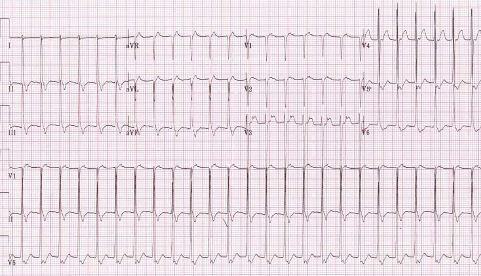 Пароксизмальная наджелудочковая тахикардия на ЭКГ