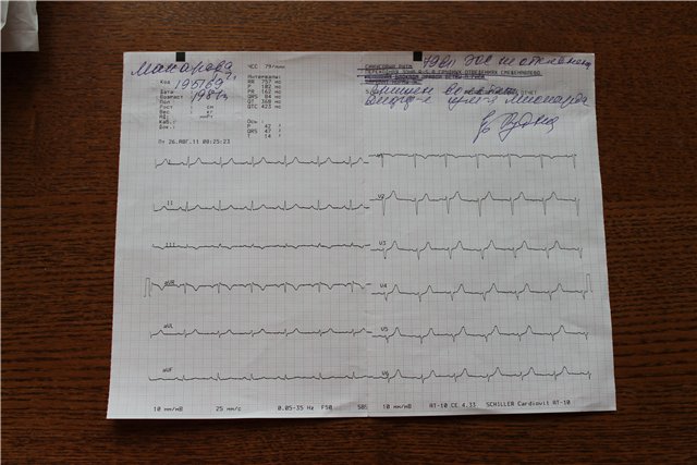 Пример ЭКГ беременной