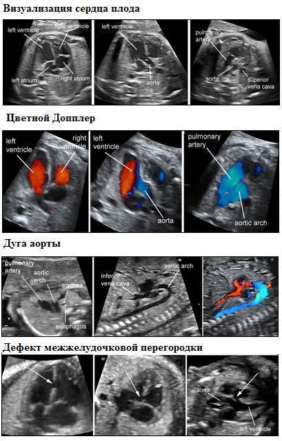 Примеры УЗИ плода